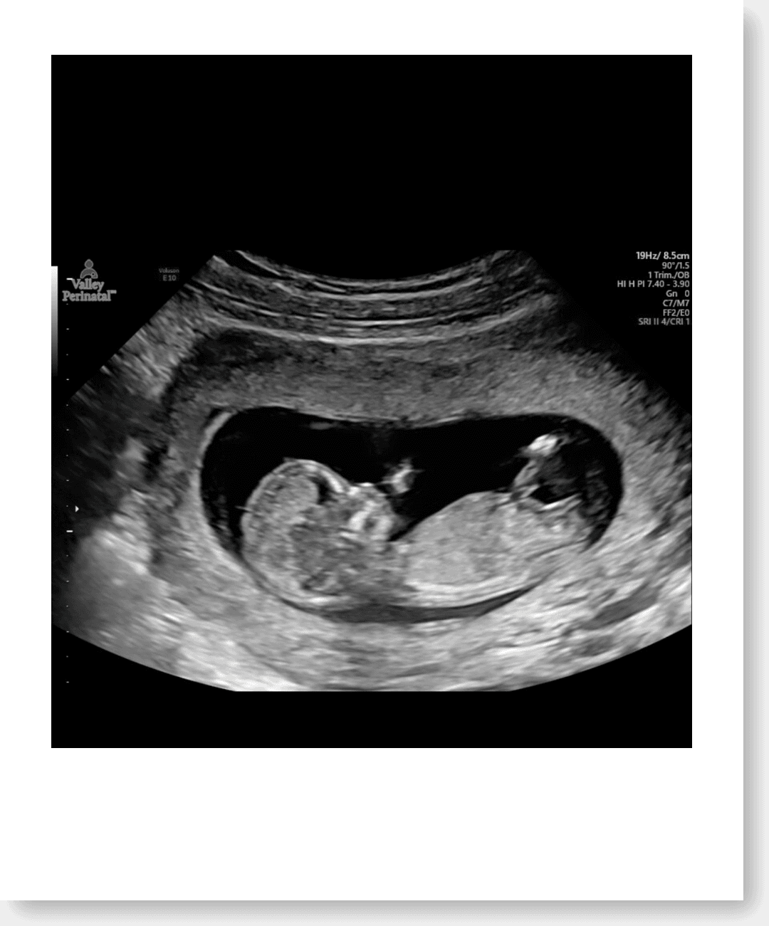 Baby King ultrasound